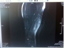 Arian Foster's sinew MRI, via Twitter